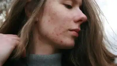Vacinas contra acne são estudadas, pesquisa revela