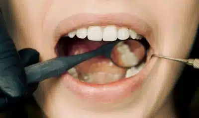 Ellyce Clonan alerta: Cannabis aumenta riscos bucais e câncer na boca