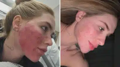 Virginia Fonseca Revela Transformação Após Tratamentos Faciais Impactantes