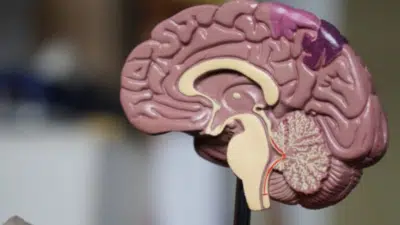 Anvisa aprova medicamento Leqembi para retardar Alzheimer em estágio inicial