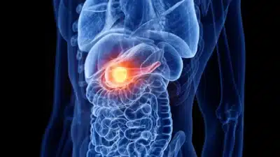 Câncer de Pâncreas: Estudo Revela Mecanismos de Invasão e Novo Alvo Terapêutico