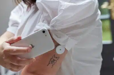 SUS Adquire Sensores de Glicose “Flash”: Inovação para Pacientes com Diabetes