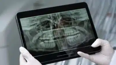 Saliva Artificial Inovadora Protege Dentes de Pacientes com Câncer de Cabeça e Pescoço