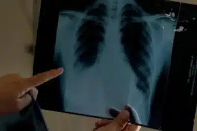 Pulmão Artificial: Inovadora Tecnologia Sustenta Paciente por 48 Horas Após Remoção de Órgãos!