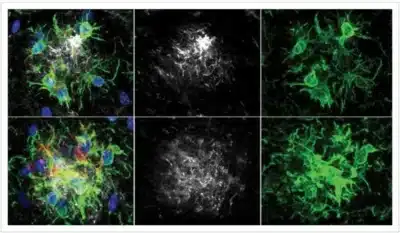 Nicholas Tonks e Cold Spring Harbor anunciam avanço promissor no tratamento do Alzheimer