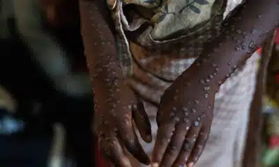 MPox: Alerta no Brasil com 88 Casos Confirmados e Crescente Tendência!