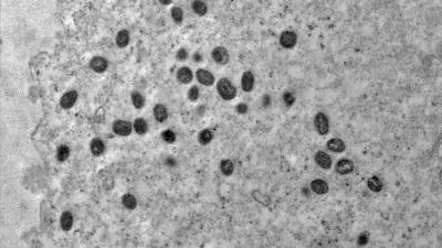 Mpox: Novo Caso Surge em Porto Alegre no Meio do Carnaval 2026 – Alerta e Prevenção!