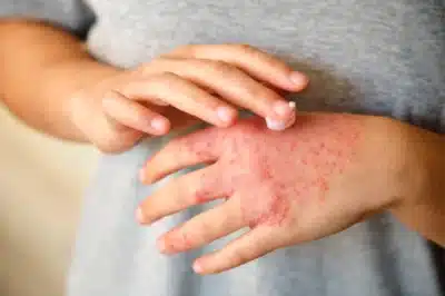 Estresse Desvenda Conexão Neurológica Crucial no Eczema: Impacto Revelador!